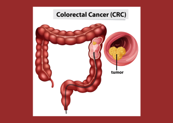 Is colorectal cancer preventable? What is it?