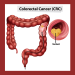 Is colorectal cancer preventable? What is it?